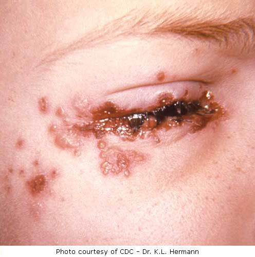 herpes pictures. 2011 Herpes Infection Symptoms